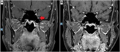 Numb cheek syndrome in breast cancer: a case report